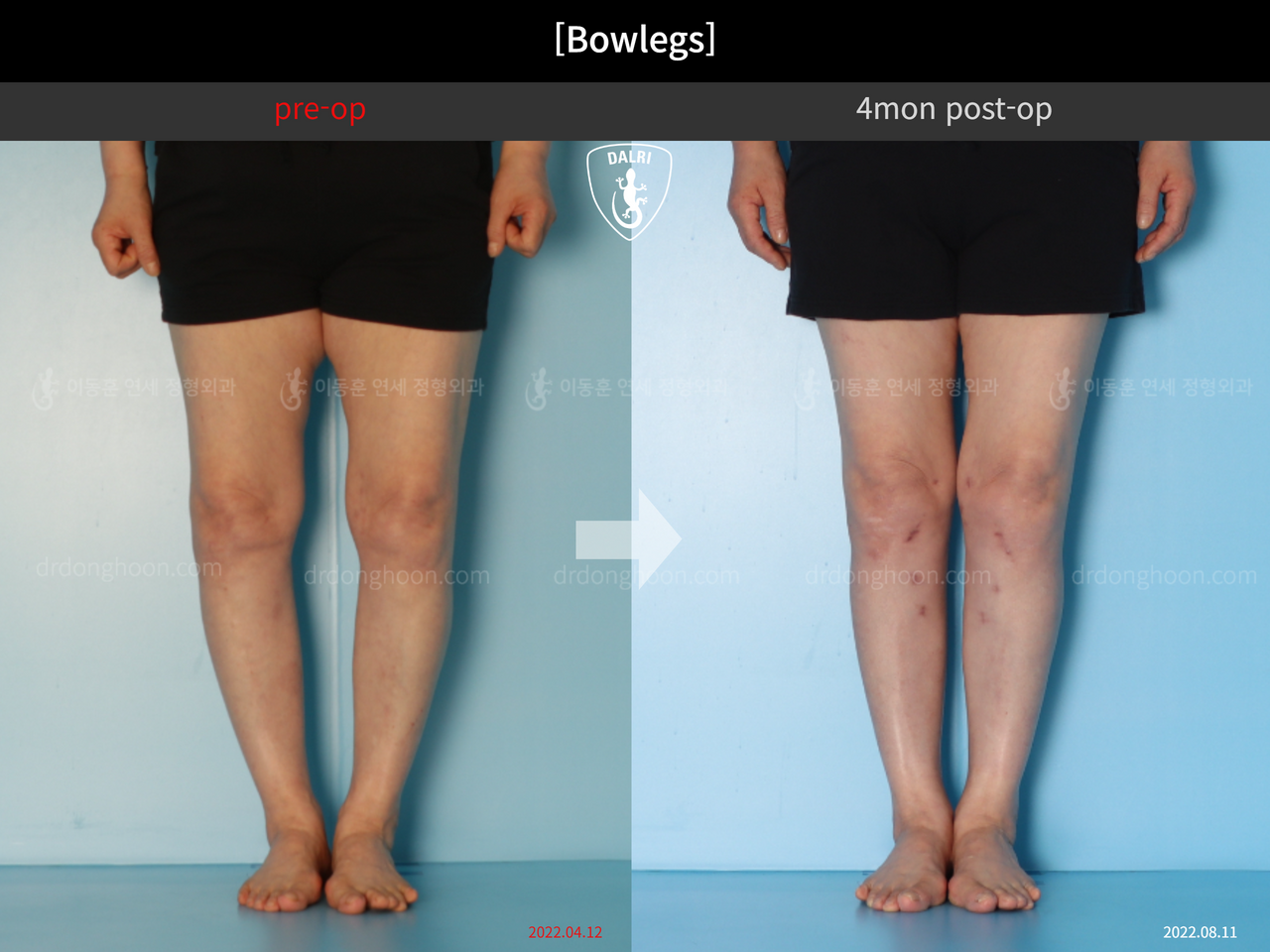 Before and after adult bowlegs, case 12586483, image 5, Dr. Donghoon institute (DALRI)