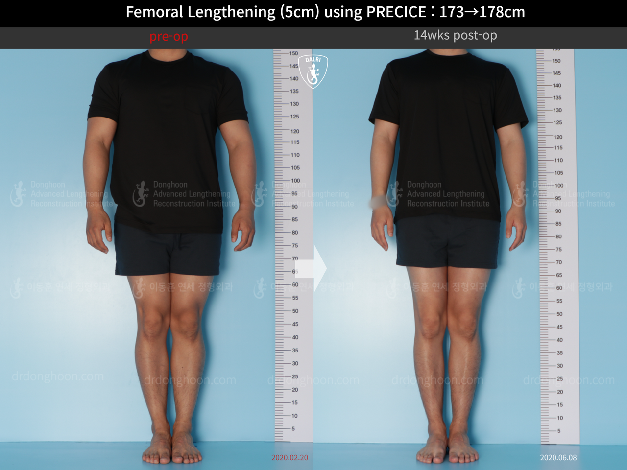 Before and after cll precice, case 14448457, image 1, Dr. Donghoon institute (DALRI)