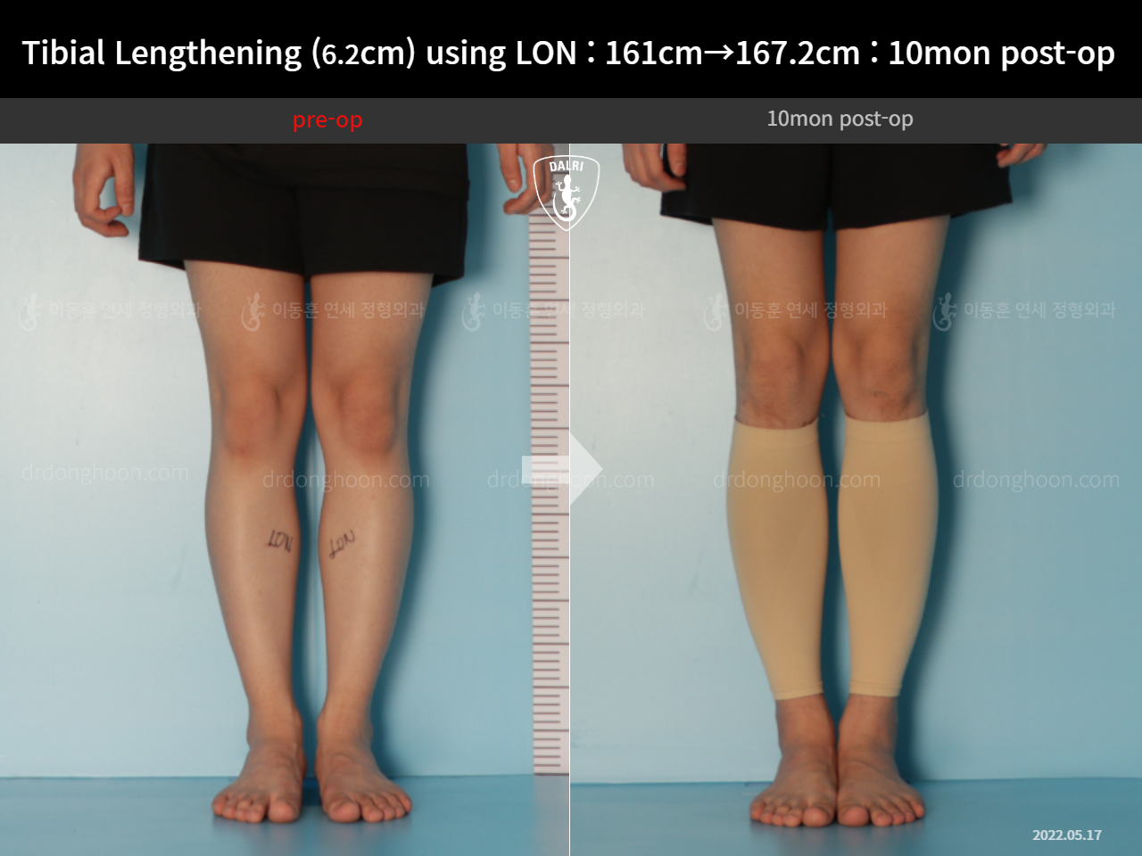Before and after cll lon, case 14502141, image 5, Dr. Donghoon institute (DALRI)