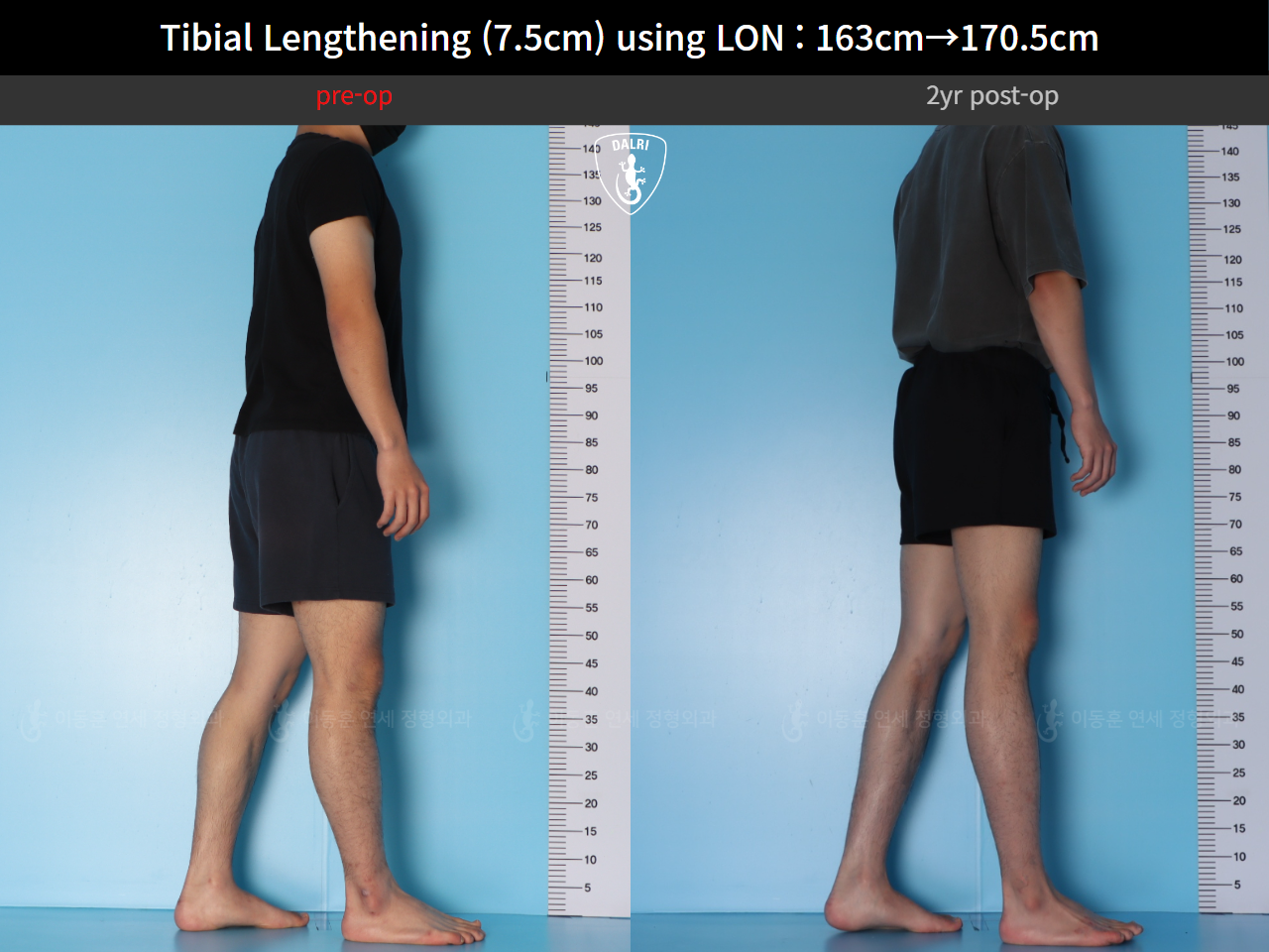 Before and after cll lon, case 125785462, image 7, Dr. Donghoon institute (DALRI)