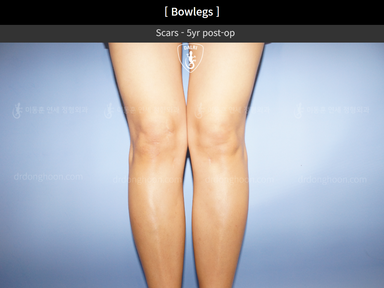 Before and after adult bowlegs, case 4311008, image 3, Dr. Donghoon institute (DALRI)