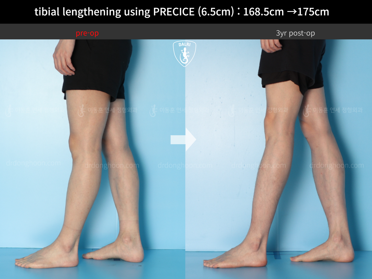 Before and after cll precice, case 13661572, image 10, Dr. Donghoon institute (DALRI)