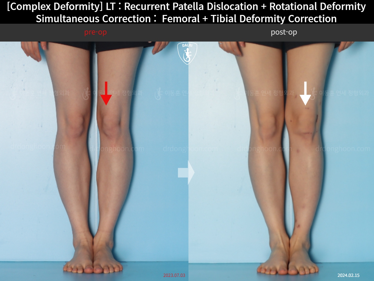 Before and after recurrent patella dislocation, case 18088207, image 2, Dr. Donghoon institute (DALRI)