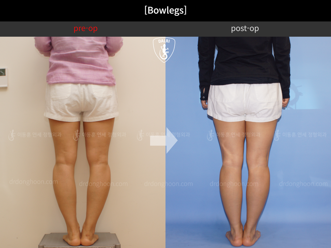 Before and after adult bowlegs, case 4311016, image 3, Dr. Donghoon institute (DALRI)