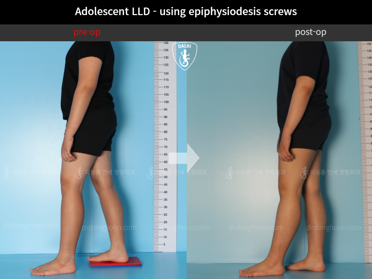 Before and after paediatric & adolescent lld, case 11472870, image 4, Dr. Donghoon institute (DALRI)