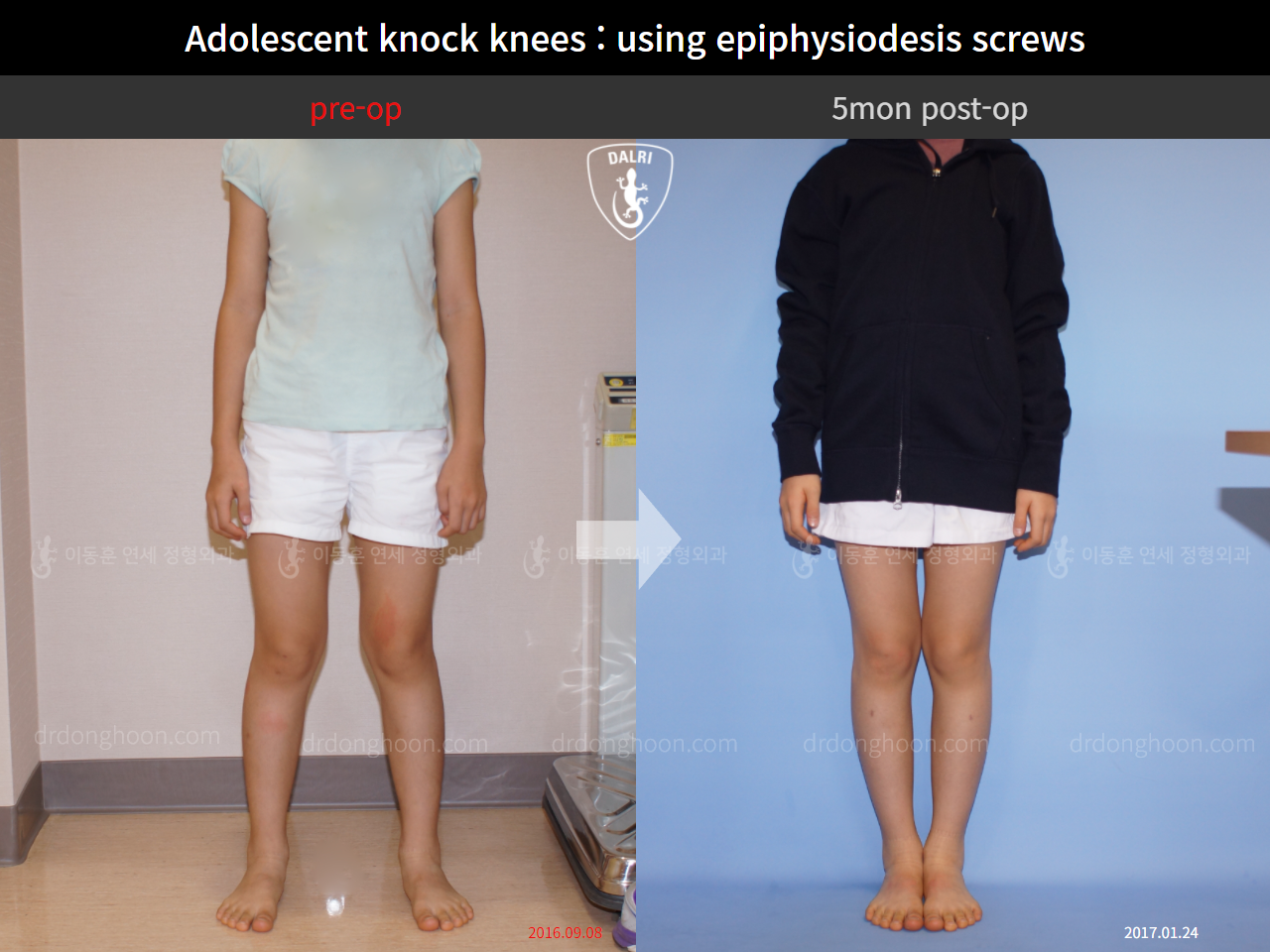 Before and after paediatric & adolescent knock knees, case 4310946, image 3, Dr. Donghoon institute (DALRI)