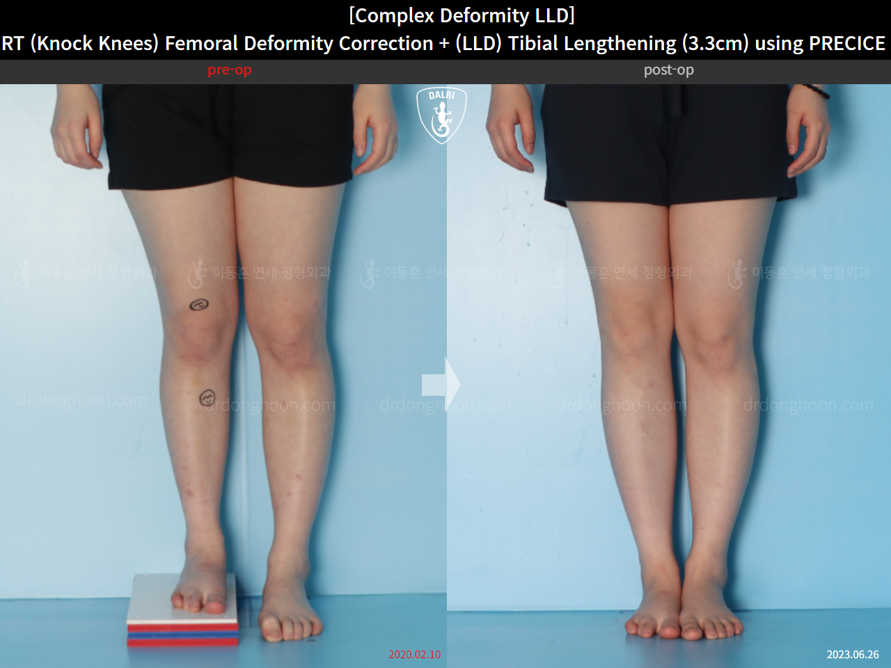 Before and after adult lld, case 15584036, image 5, Dr. Donghoon institute (DALRI)