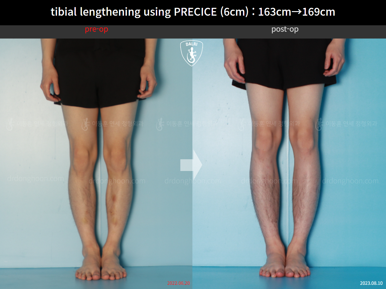Before and after cll precice, case 16061529, image 7, Dr. Donghoon institute (DALRI)
