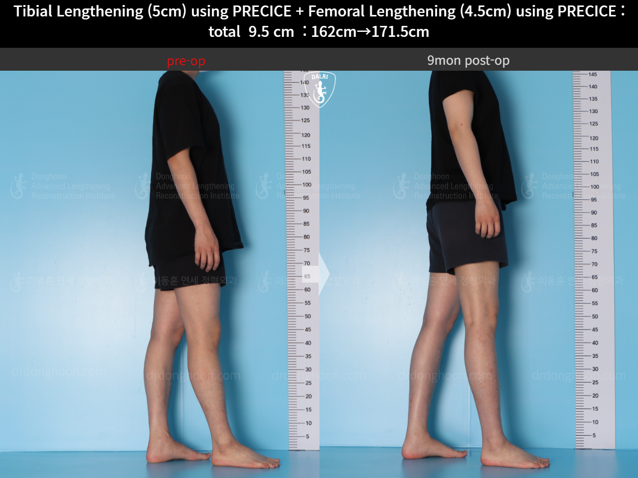 Before and after cll precice, case 15344460, image 5, Dr. Donghoon institute (DALRI)