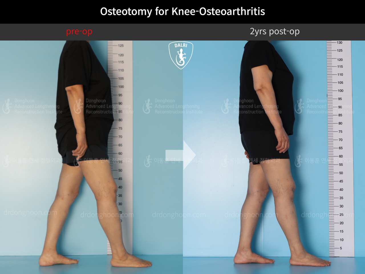 Before and after osteotomy for knee osteoarthritis, case 12844528, image 4, Dr. Donghoon institute (DALRI)
