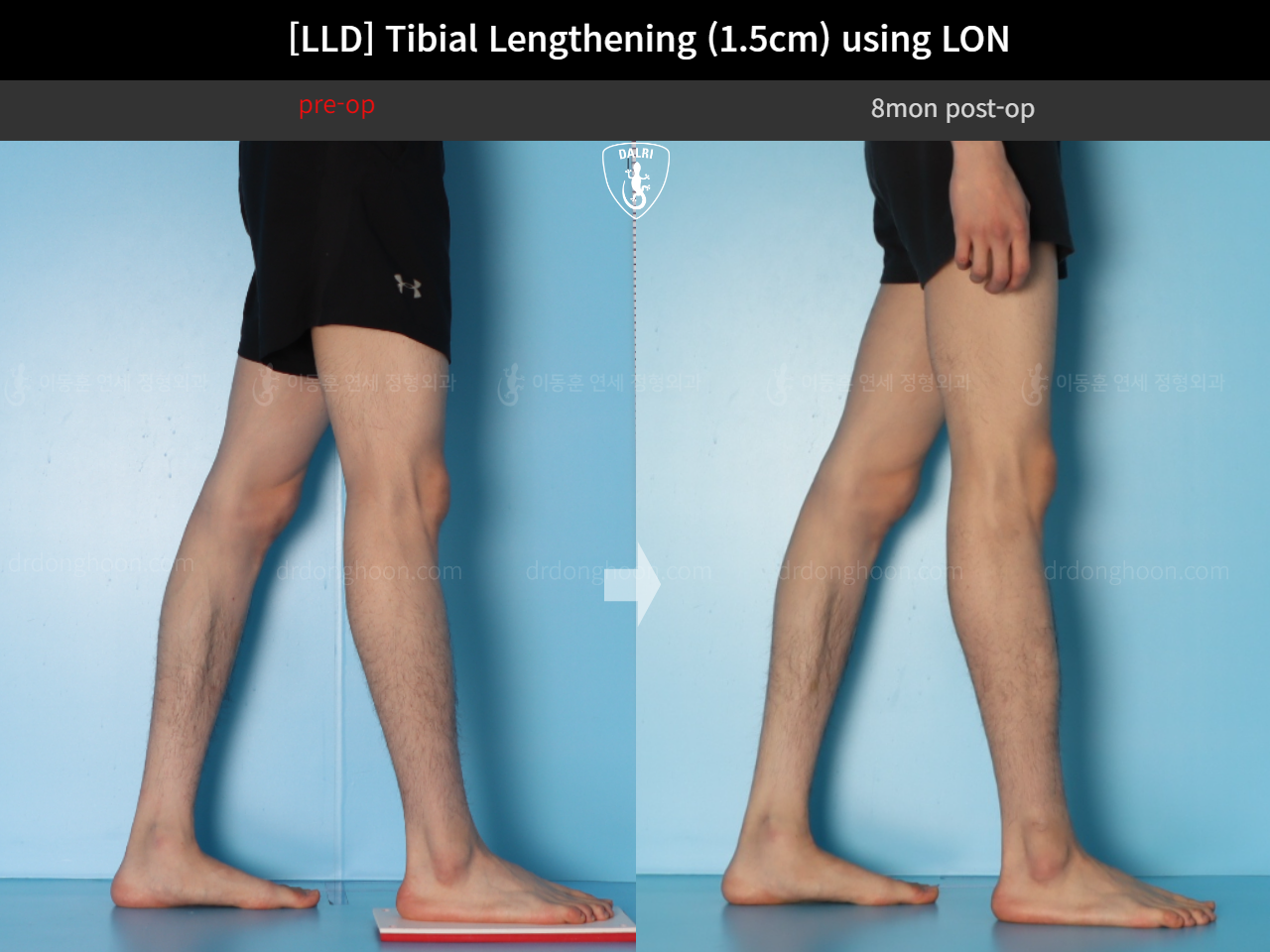 Before and after adult lld, case 18244334, image 7, Dr. Donghoon institute (DALRI)