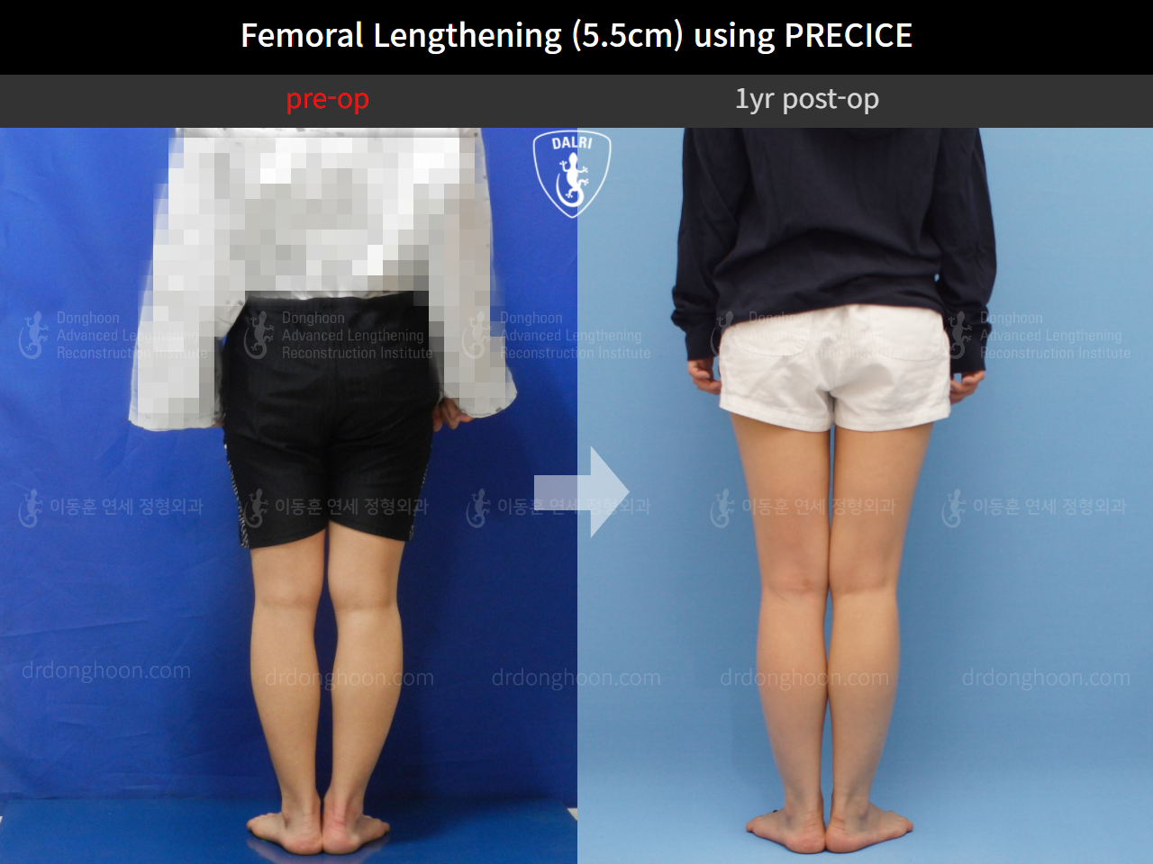 Before and after cll precice, case 4573623, image 3, Dr. Donghoon institute (DALRI)