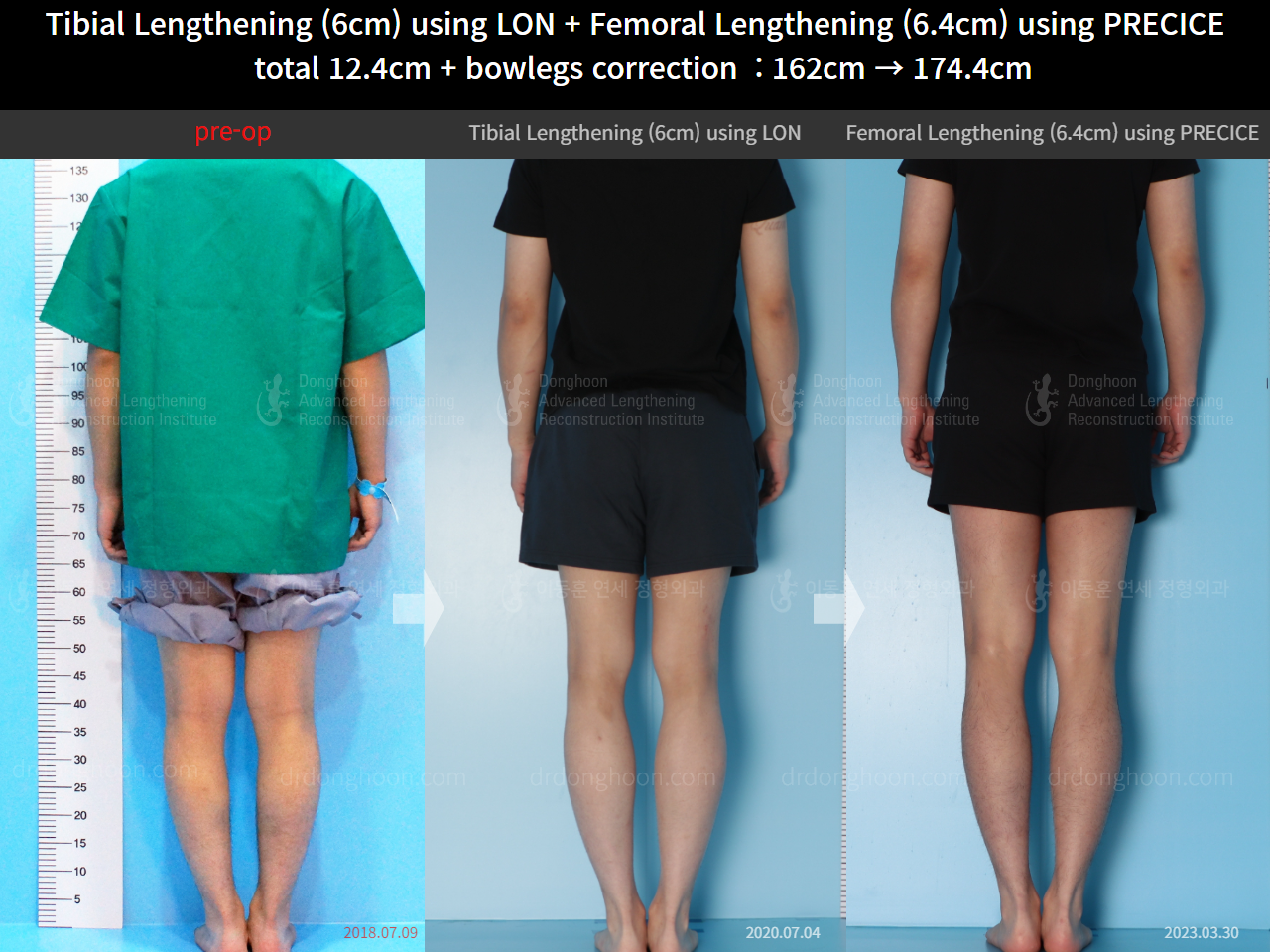 Before and after cll precice, case 14631295, image 2, Dr. Donghoon institute (DALRI)