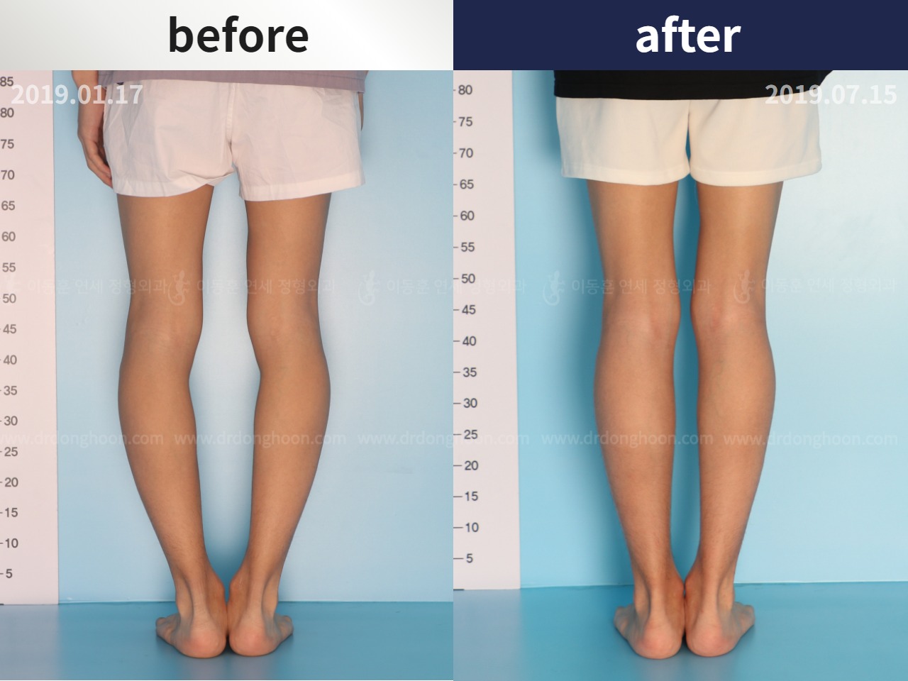 Before and after adult bowlegs, case 4311383, image 3, Dr. Donghoon institute (DALRI)