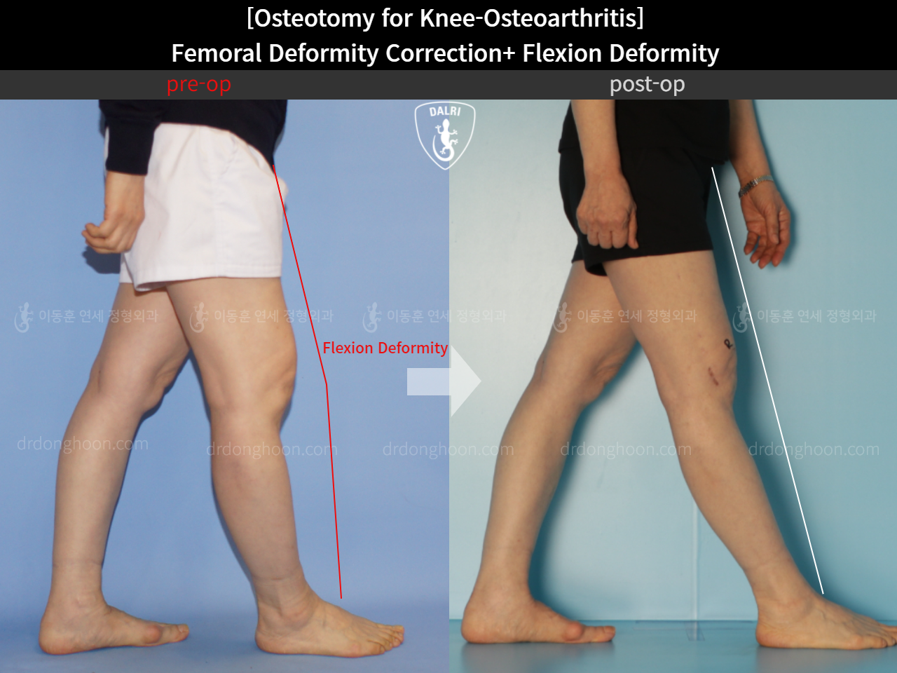 Before and after osteotomy for knee osteoarthritis, case 11380349, image 8, Dr. Donghoon institute (DALRI)