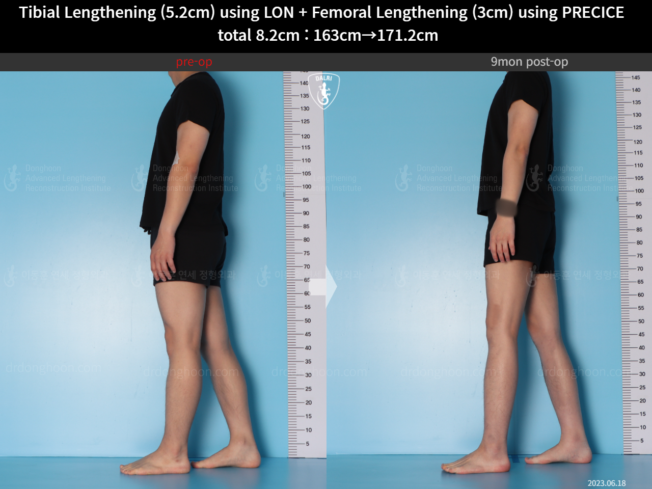 Before and after cll lon, case 15203339, image 8, Dr. Donghoon institute (DALRI)