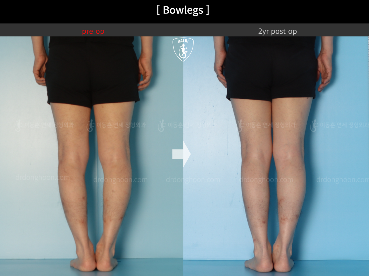 Before and after adult bowlegs, case 14445187, image 4, Dr. Donghoon institute (DALRI)