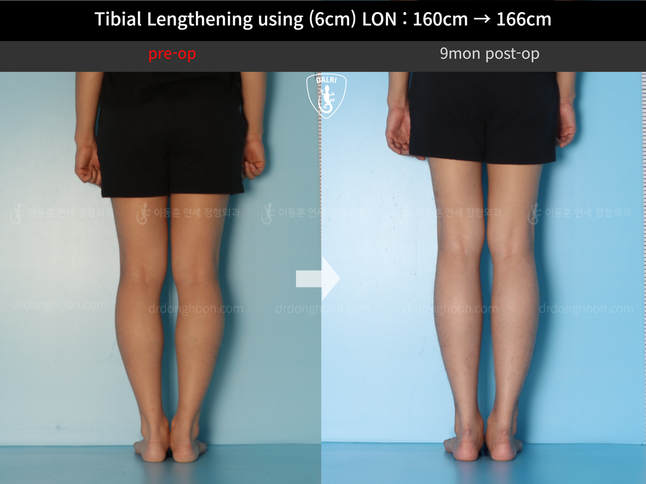 Before and after cll lon, case 13326359, image 8, Dr. Donghoon institute (DALRI)