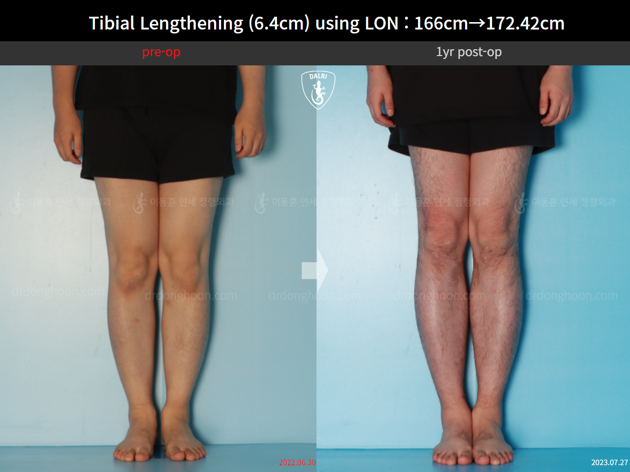 Before and after cll lon, case 15889727, image 6, Dr. Donghoon institute (DALRI)
