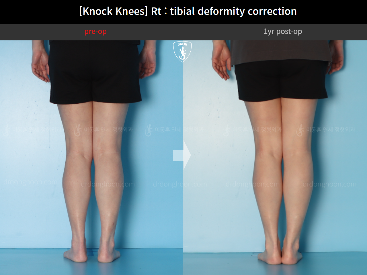 Before and after adult knock knees, case 18411627, image 7, Dr. Donghoon institute (DALRI)