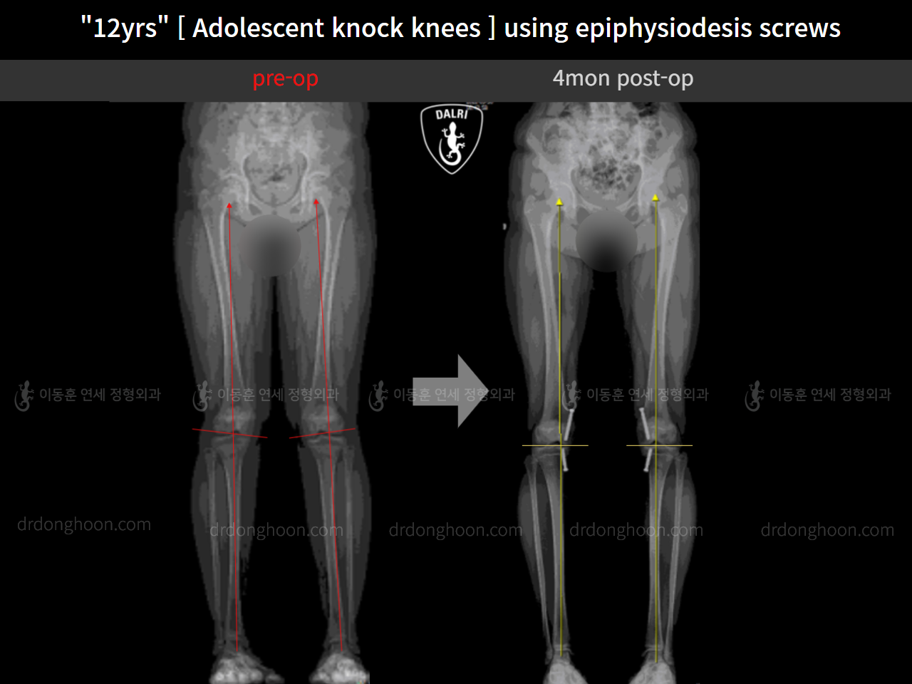 Before and after paediatric & adolescent knock knees, case 11772917, image 6, Dr. Donghoon institute (DALRI)