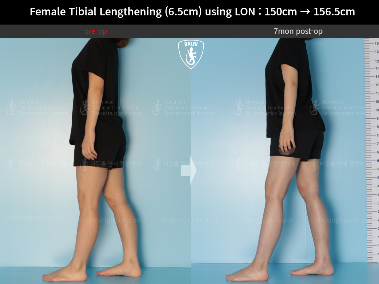 Before and after cll lon, case 16061220, image 3, Dr. Donghoon institute (DALRI)
