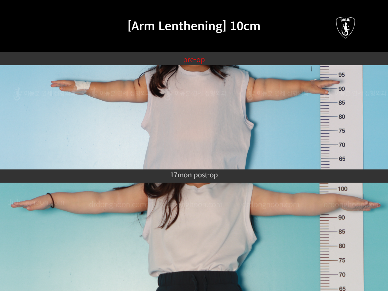 Before and after arm lengthening, case 17924395, image 3, Dr. Donghoon institute (DALRI)