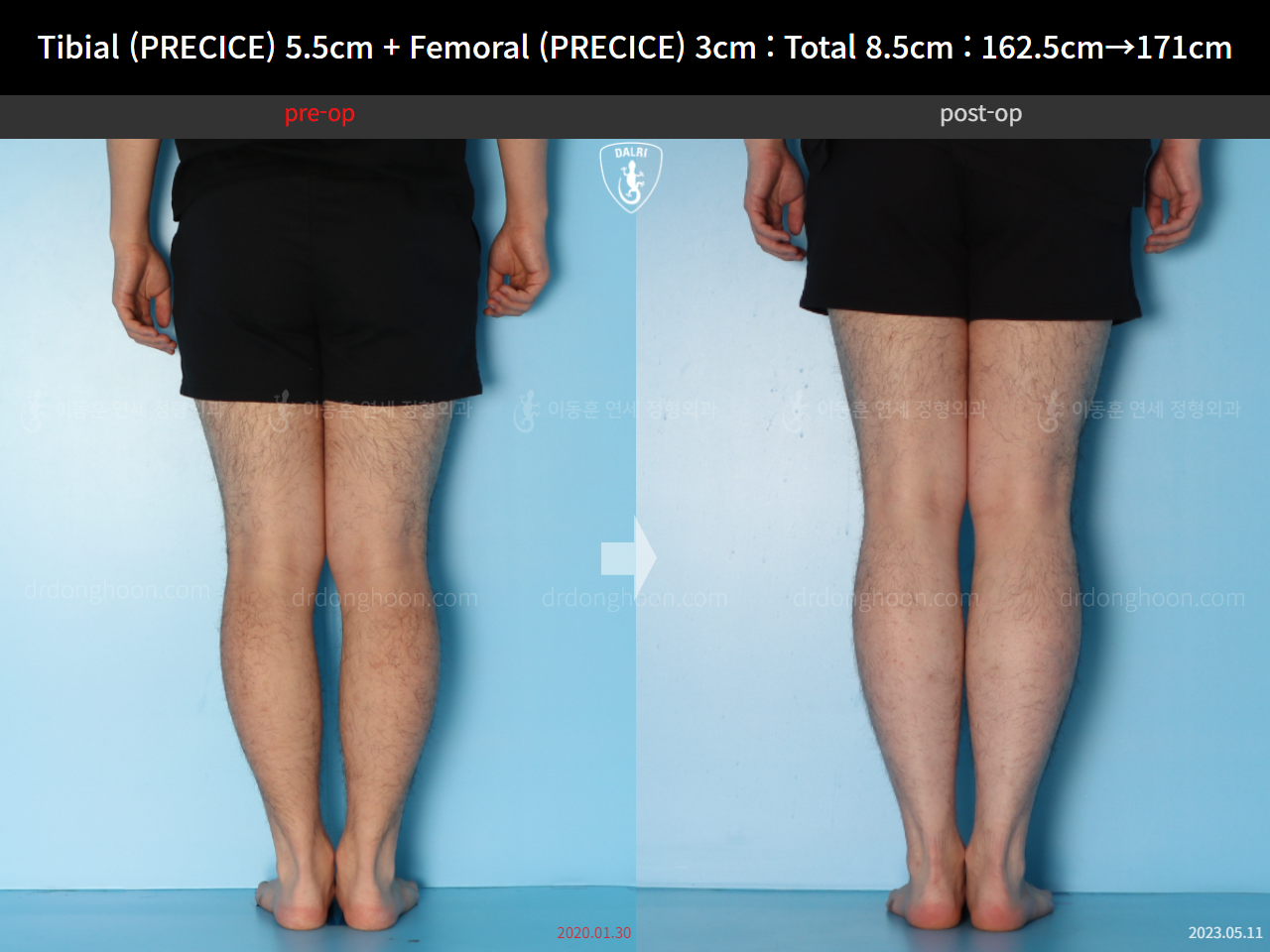 Before and after cll precice, case 15140008, image 6, Dr. Donghoon institute (DALRI)