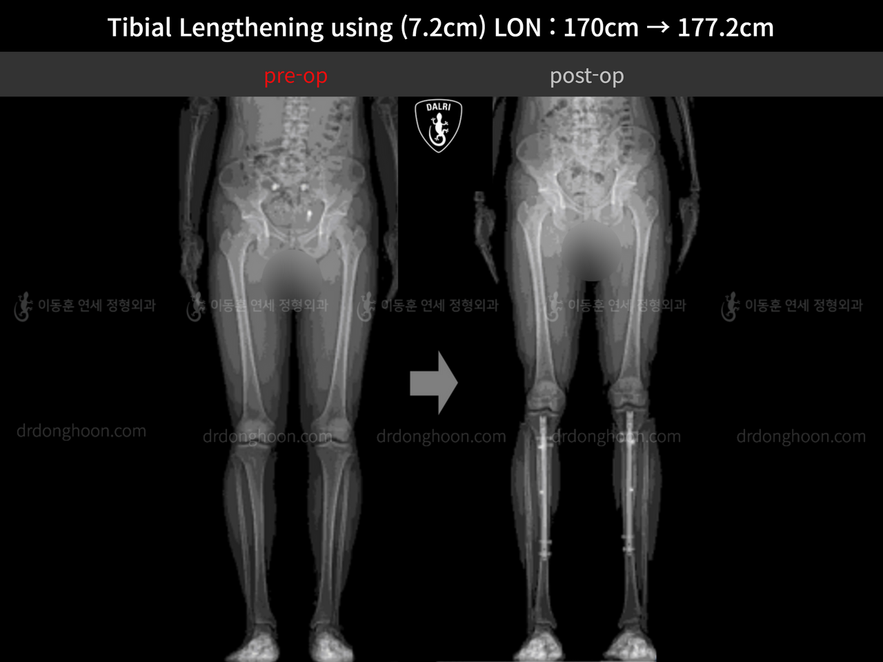 Before and after cll lon, case 13119626, image 2, Dr. Donghoon institute (DALRI)