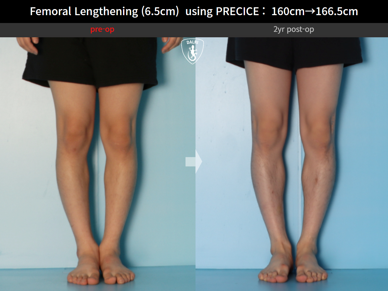 Before and after cll precice, case 27369651, image 7, Dr. Donghoon institute (DALRI)