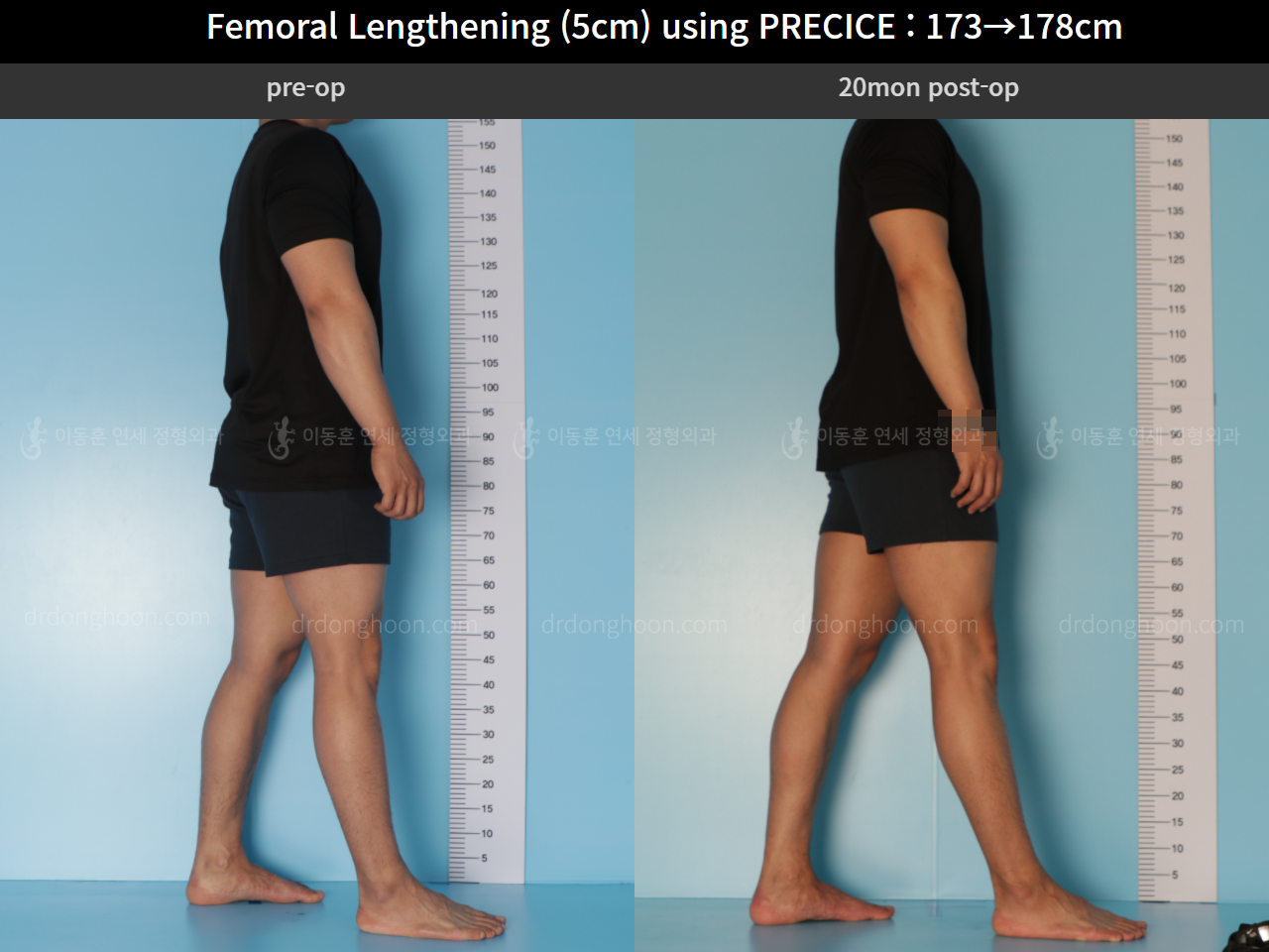 Before and after cll precice, case 4573533, image 3, Dr. Donghoon institute (DALRI)