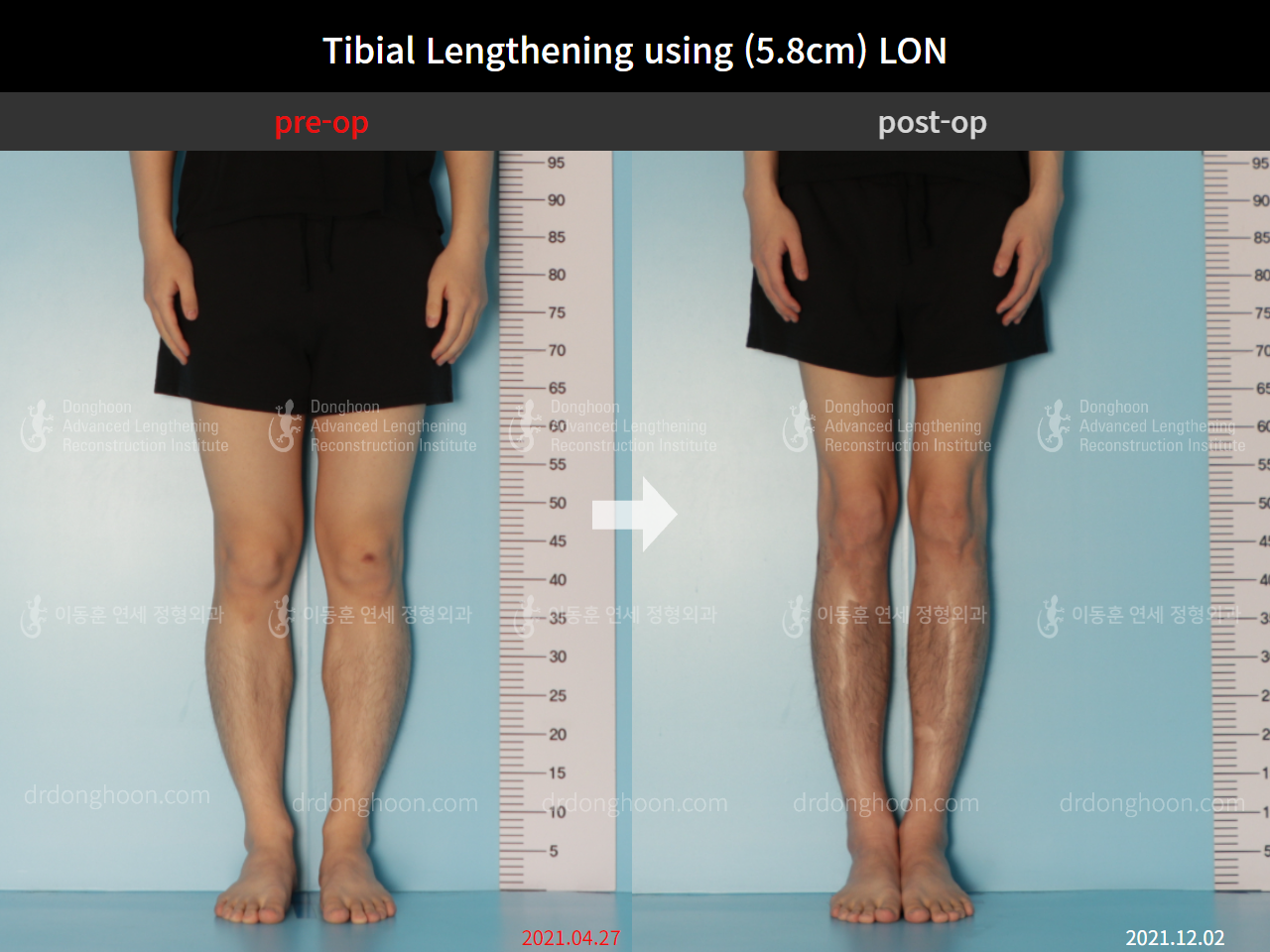 Before and after cll lon, case 9047470, image 3, Dr. Donghoon institute (DALRI)