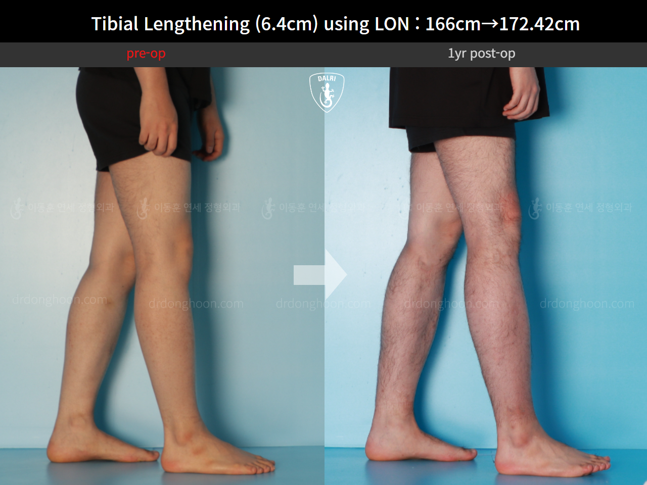 Before and after cll lon, case 15889727, image 8, Dr. Donghoon institute (DALRI)