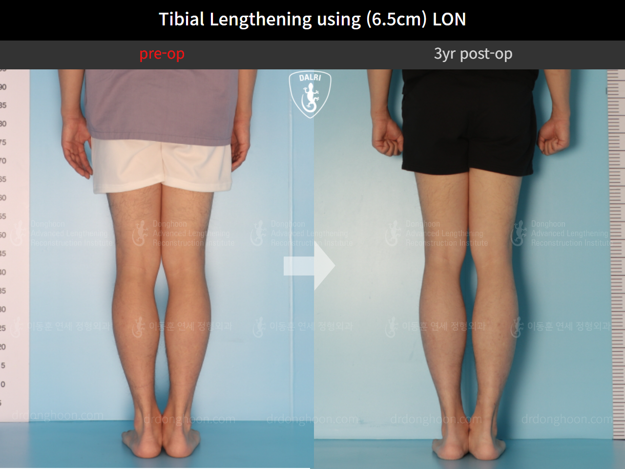 Before and after cll lon, case 9487829, image 6, Dr. Donghoon institute (DALRI)