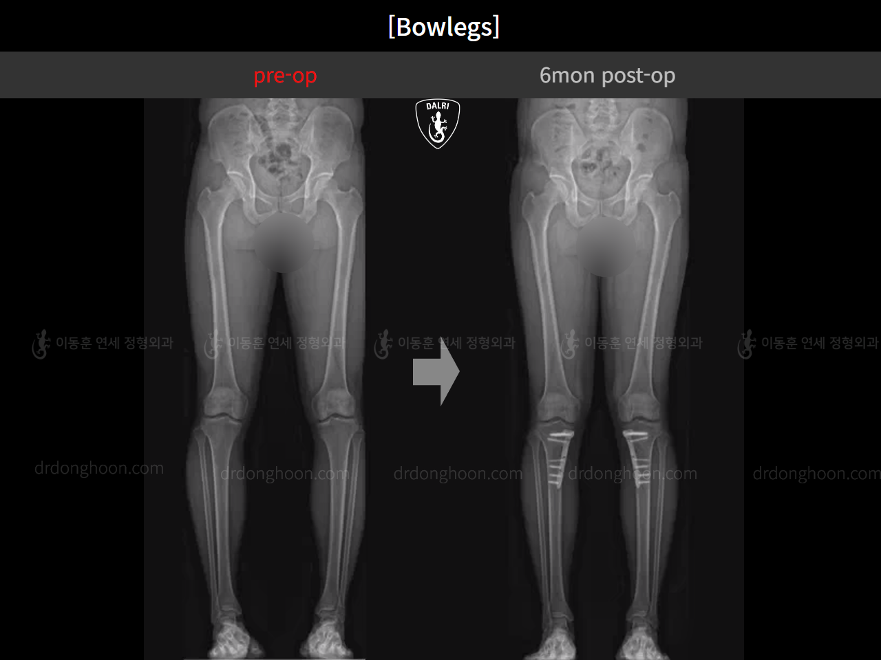 Before and after adult bowlegs, case 14742489, image 10, Dr. Donghoon institute (DALRI)