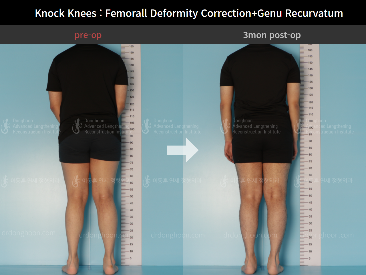 Before and after adult knock knees, case 7165631, image 2, Dr. Donghoon institute (DALRI)