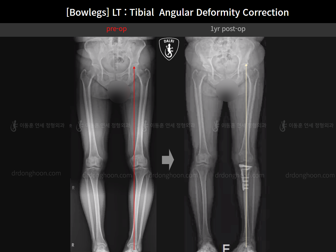 Before and after adult bowlegs, case 16787003, image 10, Dr. Donghoon institute (DALRI)