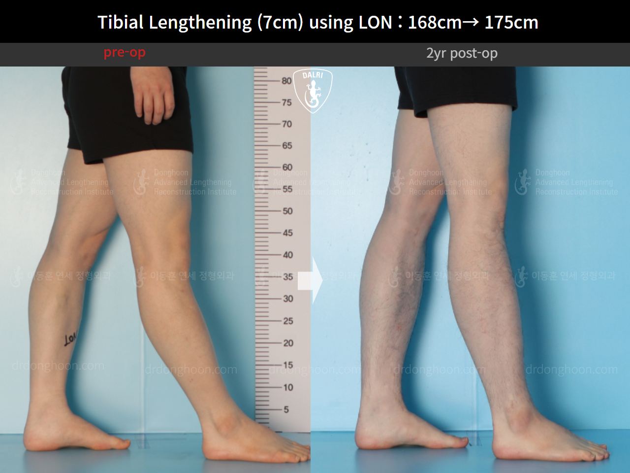 Before and after cll lon, case 14978046, image 11, Dr. Donghoon institute (DALRI)
