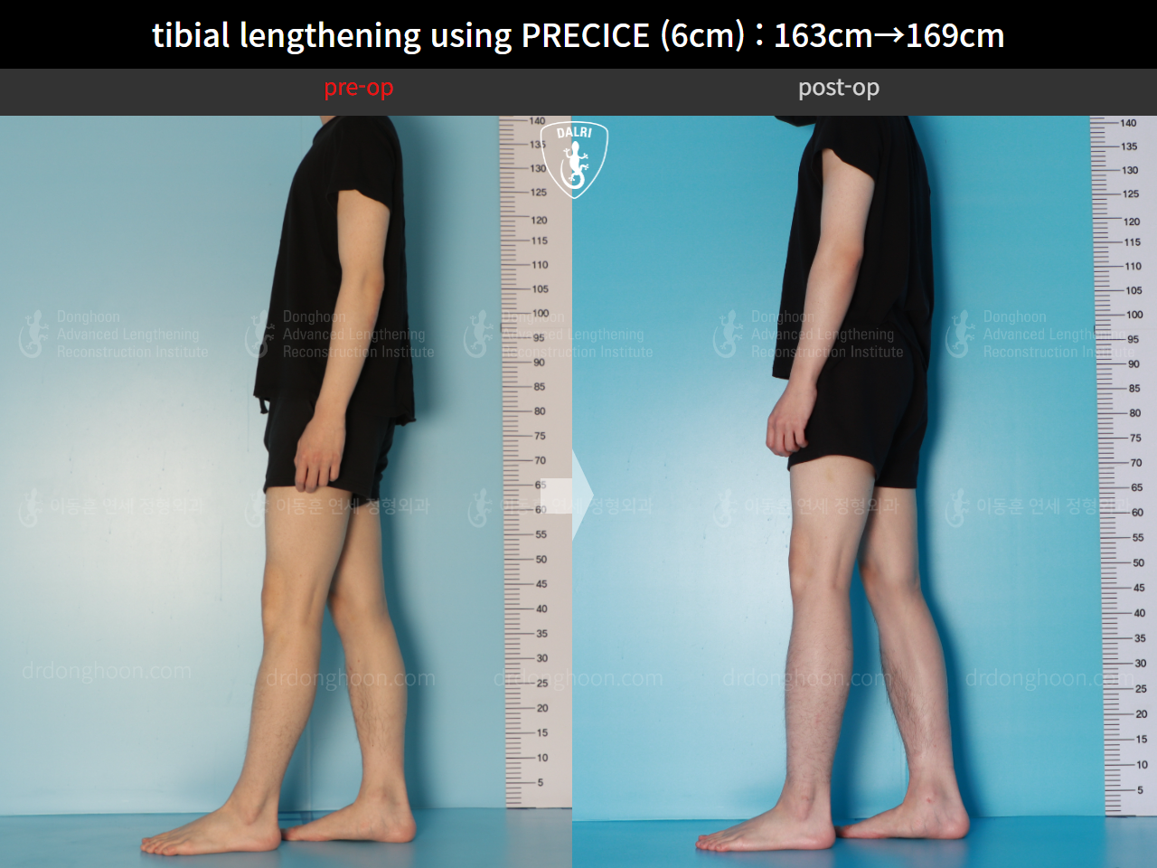 Before and after cll precice, case 16061529, image 5, Dr. Donghoon institute (DALRI)
