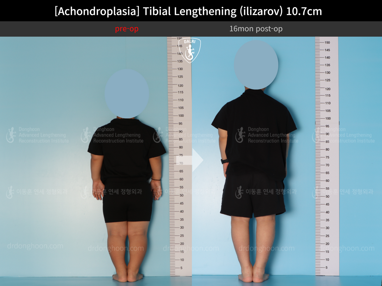 Before and after paediatric congenital condition, case 13489647, image 2, Dr. Donghoon institute (DALRI)
