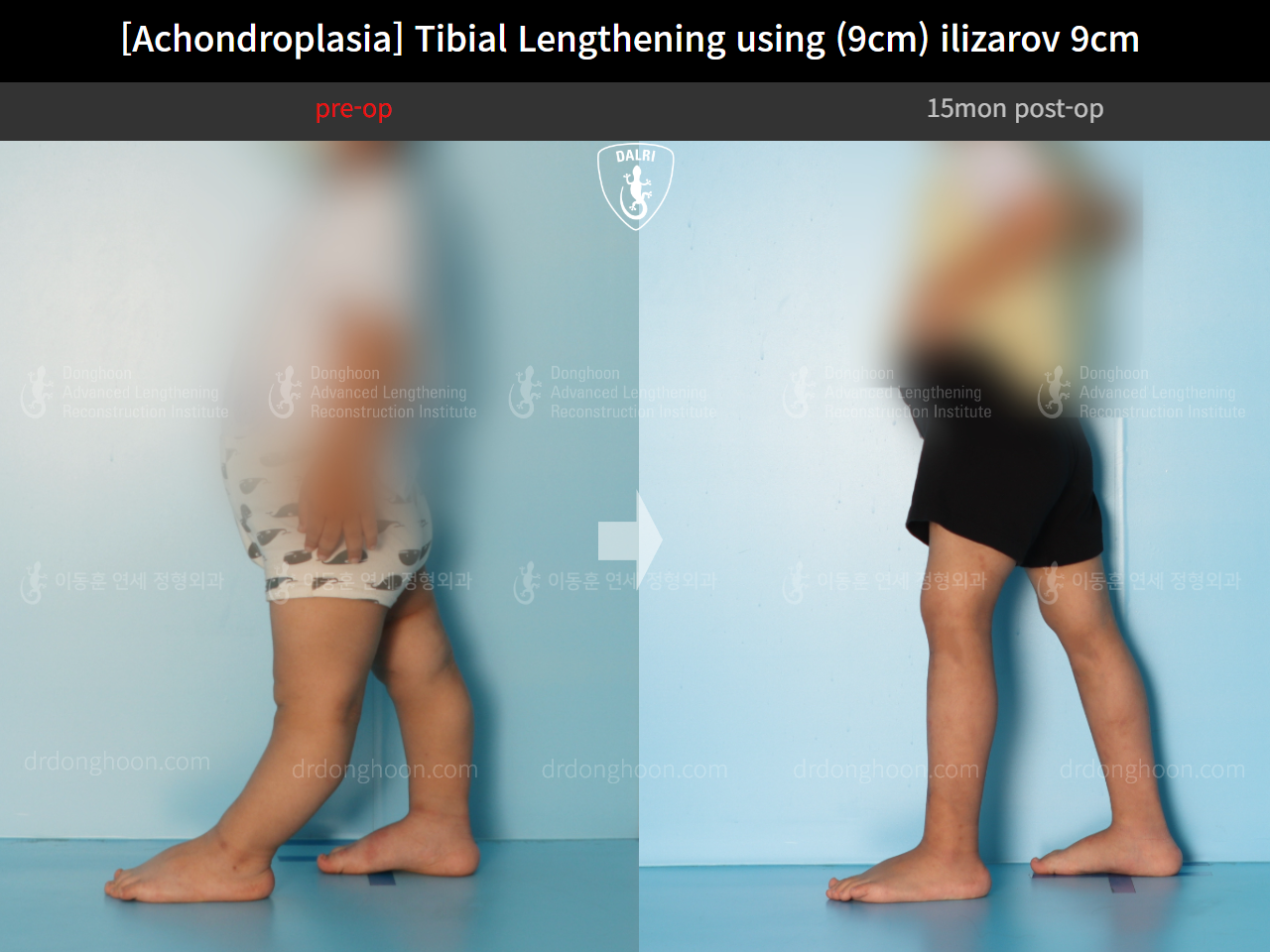 Before and after paediatric congenital condition, case 14542054, image 3, Dr. Donghoon institute (DALRI)