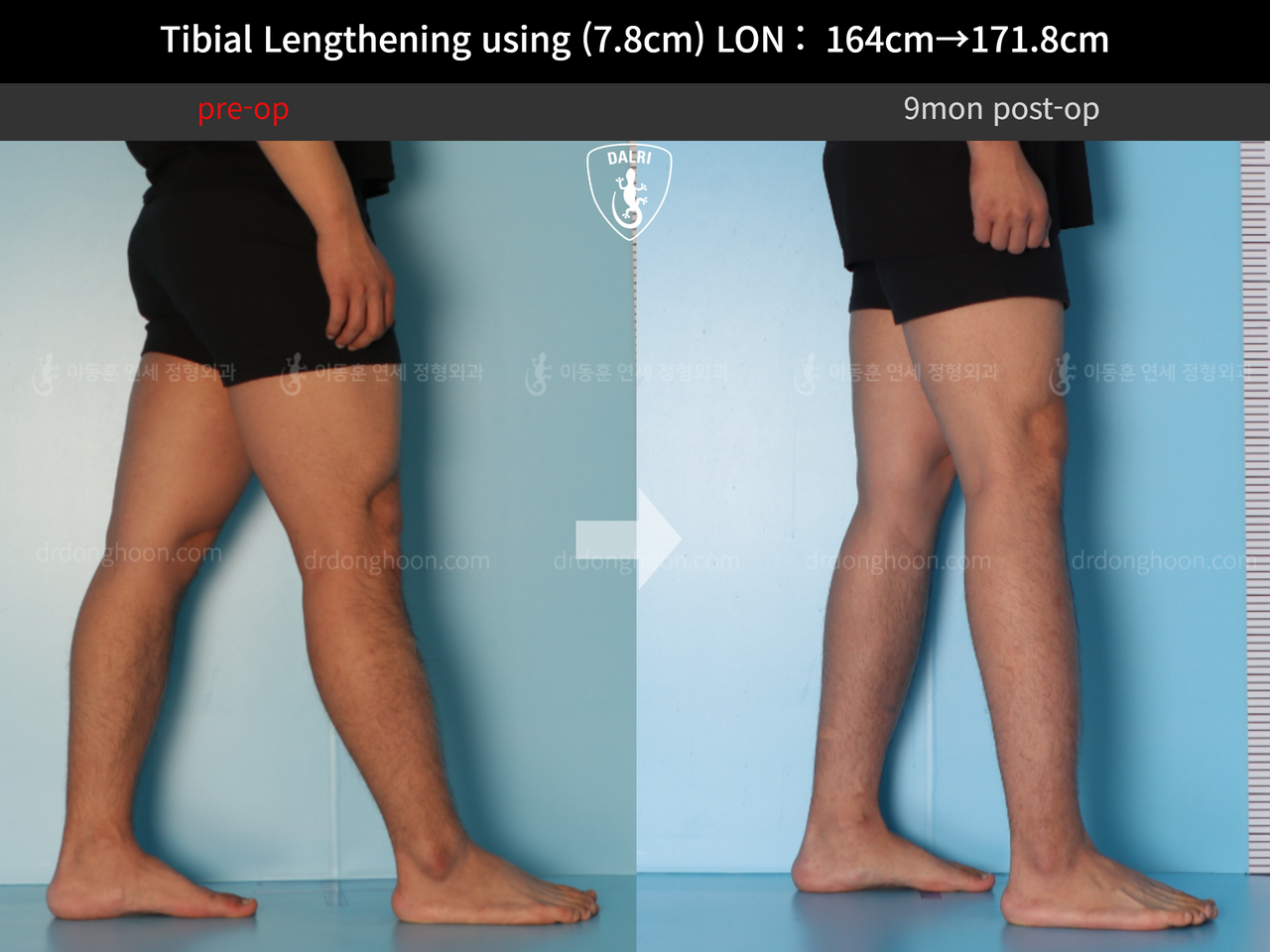 Before and after cll lon, case 12652002, image 7, Dr. Donghoon institute (DALRI)