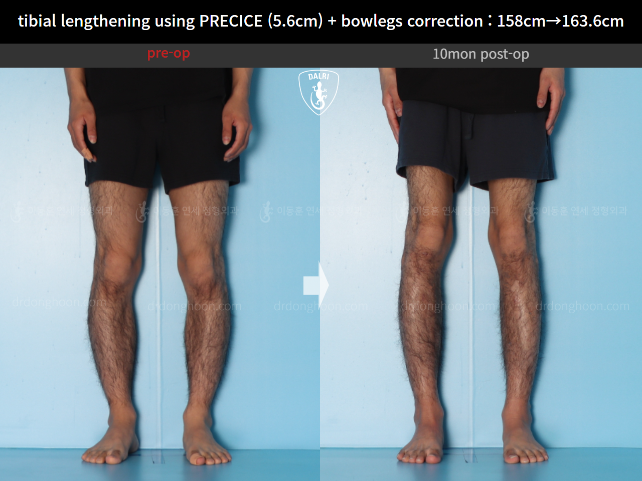 Before and after cll + deformity correction, case 15043777, image 5, Dr. Donghoon institute (DALRI)