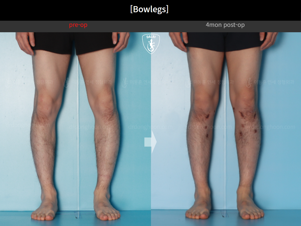 Before and after adult bowlegs, case 21098909, image 8, Dr. Donghoon institute (DALRI)