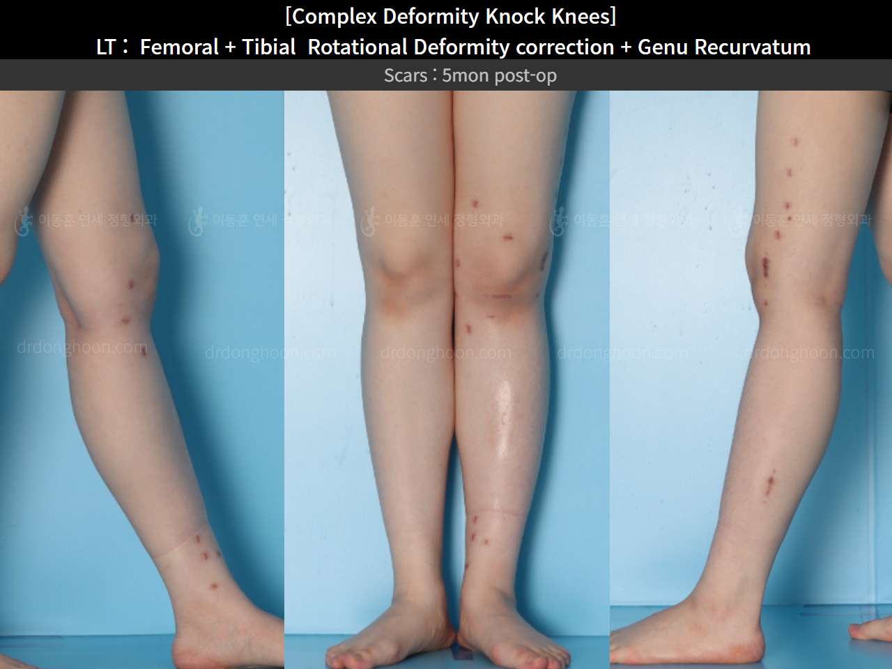 Before and after genu recurvatum, case 16212778, image 12, Dr. Donghoon institute (DALRI)