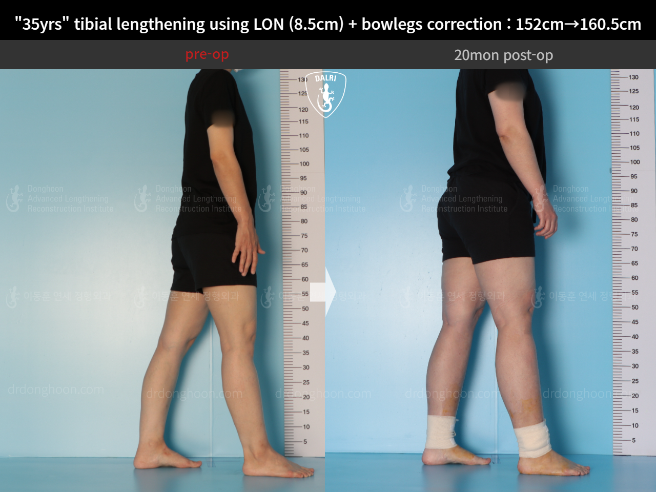 Before and after cll lon, case 15036651, image 5, Dr. Donghoon institute (DALRI)