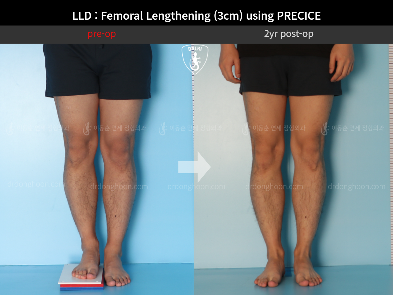 Before and after adult lld, case 10665047, image 3, Dr. Donghoon institute (DALRI)