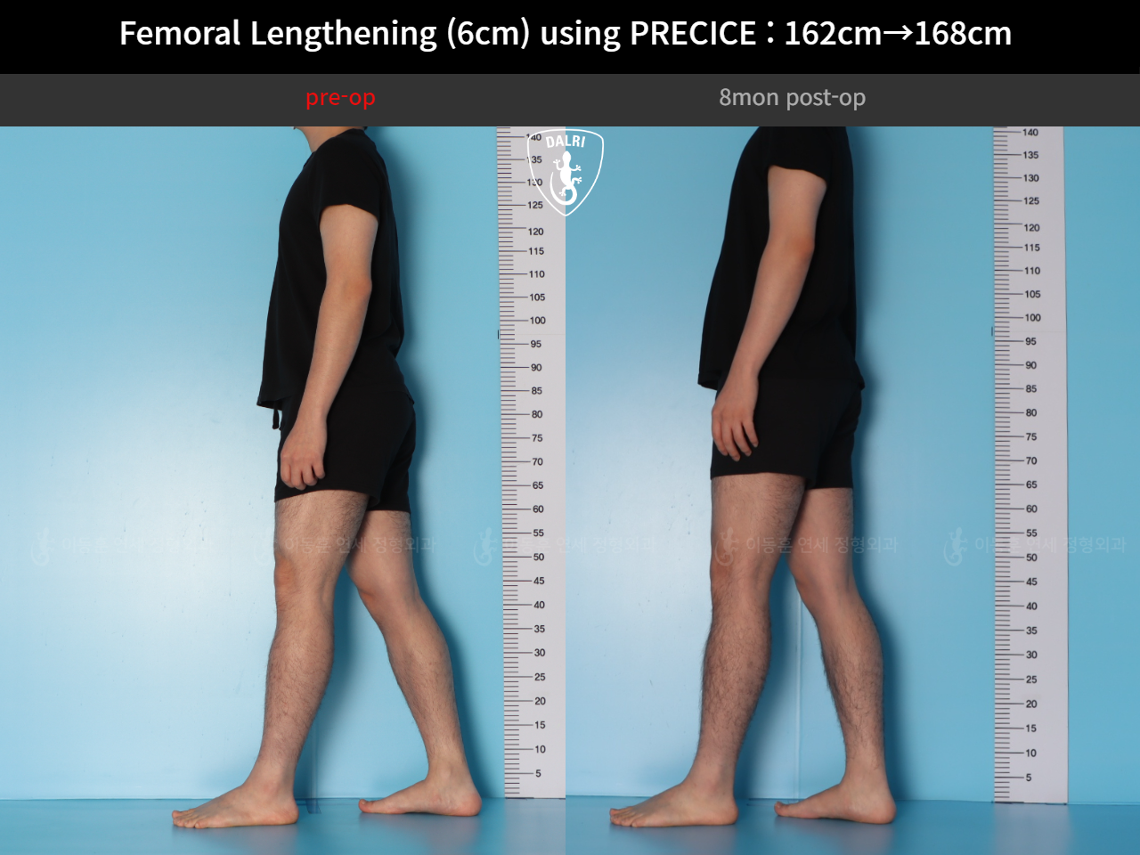 Before and after cll precice, case 52565195, image 3, Dr. Donghoon institute (DALRI)