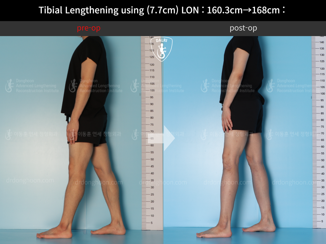 Before and after cll lon, case 12643440, image 4, Dr. Donghoon institute (DALRI)