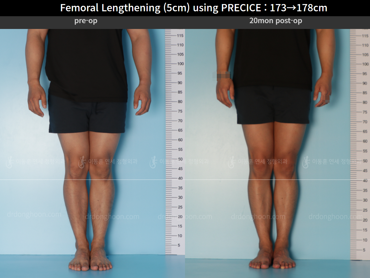 Before and after cll precice, case 4573533, image 5, Dr. Donghoon institute (DALRI)